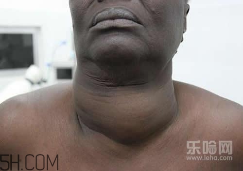 甲狀腺腫大和甲亢的區(qū)別有哪些？甲狀腺腫大適合吃什么食物？