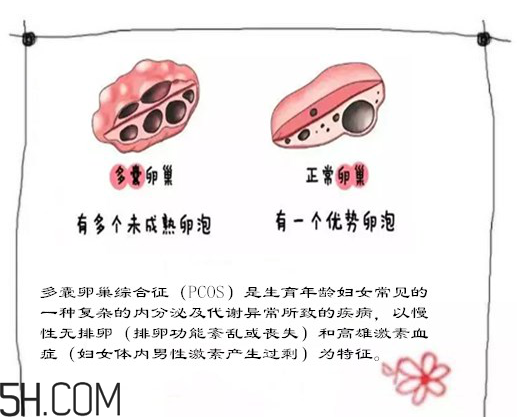 多囊卵巢生不了？多囊卵巢懷孕要看準(zhǔn)時(shí)間