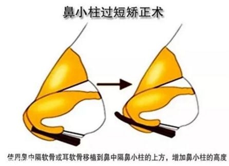 鼻小柱延長(zhǎng)用什么材料？?jī)?yōu)先選擇鼻中隔軟骨