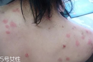 螨蟲有哪些危害？嚴(yán)重時(shí)肌膚糜爛