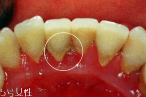 牙結(jié)石能自動(dòng)脫落嗎？除了洗牙別無(wú)他法