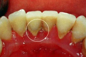 牙結(jié)石能自動脫落嗎？除了洗牙別無他法