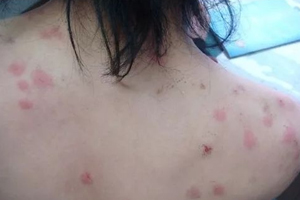 螨蟲有哪些危害？嚴(yán)重時肌膚糜爛