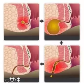 肛瘺非手術(shù)治療才可以嗎？手術(shù)是治療的關(guān)鍵途徑