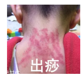 吮痧有什么療效？最溫柔的治病方法