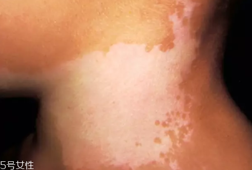 痣什么情況下會轉變?yōu)榱觯奎c痣不可取