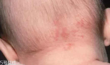 痣什么情況下會轉變?yōu)榱?？點痣不可取