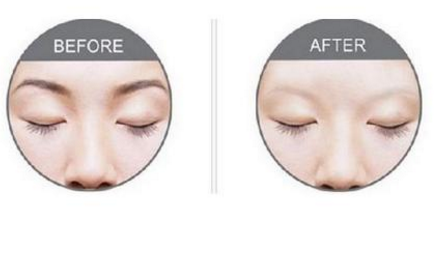 激光洗眉恢復(fù)期有疤痕怎么辦？激光洗眉毛之后正確護(hù)理方法