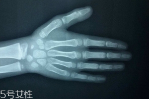 哪些人需要測(cè)骨齡？長(zhǎng)太快警惕骨齡提前