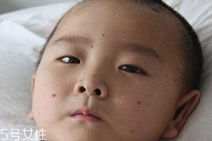 痣什么情況下會轉變?yōu)榱?？點痣不可取