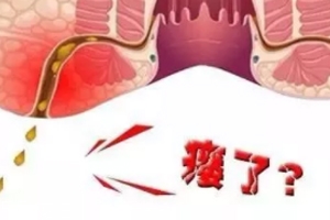 肛瘺非手術(shù)治療才可以嗎？手術(shù)是治療的關(guān)鍵途徑