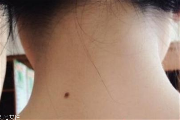 脖子后面有痣好嗎？激光冷凍祛痣易導致癌變