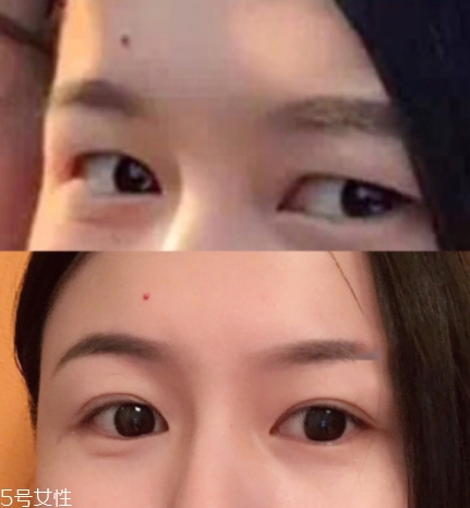 內(nèi)雙怎么進化成雙眼皮？全是雙眼皮貼的功勞