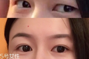 內(nèi)雙怎么進化成雙眼皮？全是雙眼皮貼的功勞