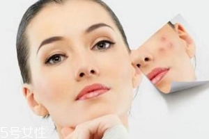 痘印多久能自行消失？多數(shù)人一年內(nèi)消失