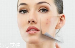 痘印多久能自行消失？多數(shù)人一年內(nèi)消失