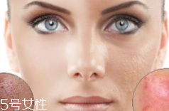 痘印多久能自行消失？多數(shù)人一年內(nèi)消失