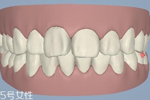 磨牙有哪些癥狀？牙齒變形甚至脫落