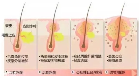 封閉性粉刺的發(fā)病機(jī)制是什么？角質(zhì)層太厚