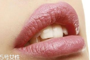 冬天爛嘴角什么原因？有可能營養(yǎng)不良