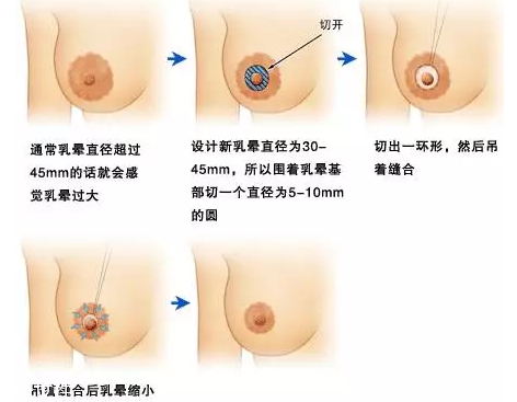 乳暈縮小術(shù)怎么做？乳暈縮小術(shù)知識全解