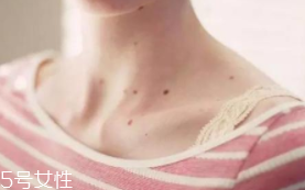 色素痣是腫瘤嗎？良性腫瘤不必?fù)?dān)心