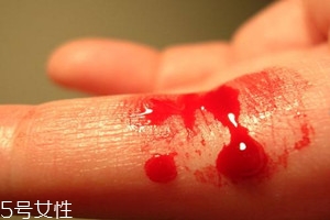 血友病的主要表現(xiàn)有哪些？出血是最明顯的特征