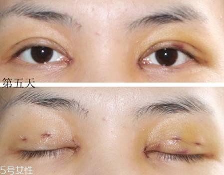 怎么縮短開眼角疤痕消失時間？雙眼皮開眼角恢復過程