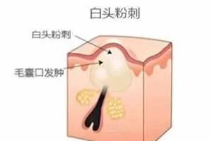 閉口是怎么引起的？4種情況要注意