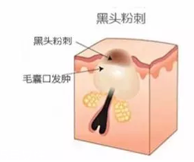 閉口是怎么引起的？4種情況要注意