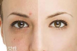 祛痘產(chǎn)品怎么選？先要分清痘印類型
