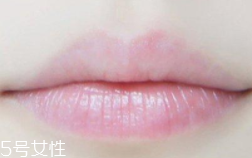 嘴唇干裂是一種病嗎？治療口角炎從改善習(xí)慣入手