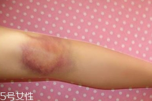 身體淤青怎么來的？不是磕碰那么簡單