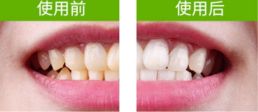 牙貼怎么分上下牙貼？牙貼怎么分正反