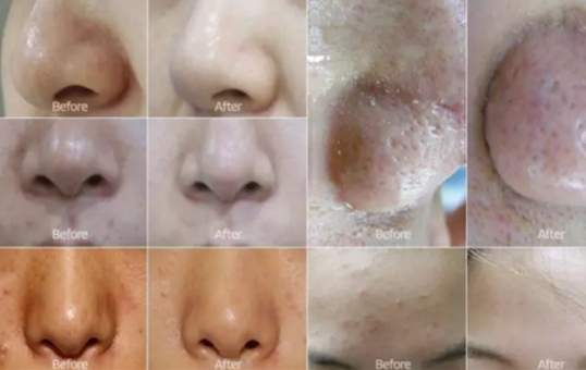弄完小氣泡多久可以化妝？小氣泡注意事項(xiàng)