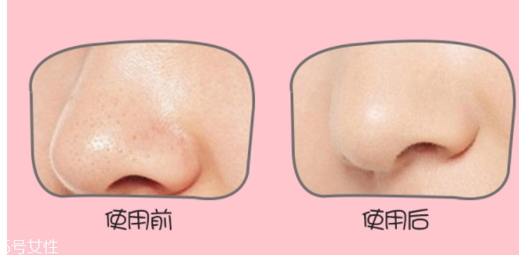 yoii黑頭儀怎么用？yoii黑頭儀怎么充電