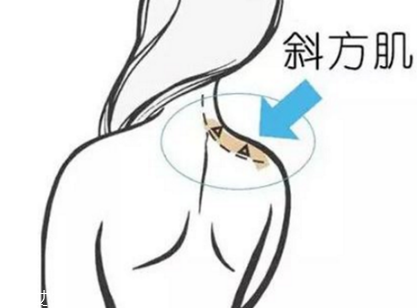 瘦肩針間隔多久打一次？打瘦肩針間隔時間