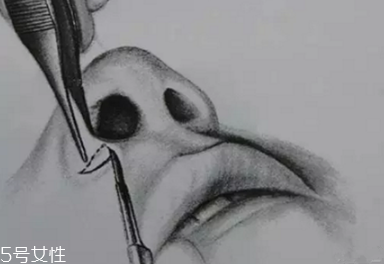 鼻翼外切多久消腫？鼻翼外切消腫時(shí)間要多長？
