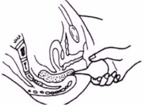 開塞露躺著還是蹲著用？開塞露使用姿勢