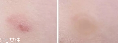 vt痘痘貼怎么用？vt老虎痘痘貼防水嗎