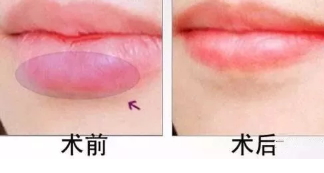 厚唇變薄術注意事項 厚唇變薄術術后護理