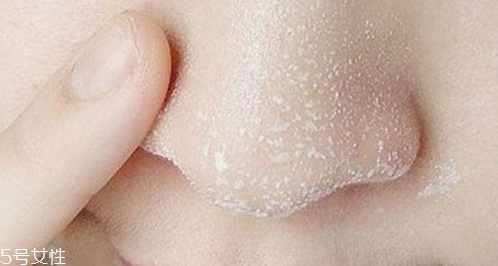 黑頭不管它會變大嗎？黑頭不管它會怎樣？