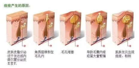 頑固痘痘怎么消除？油皮為什么反復爆痘？