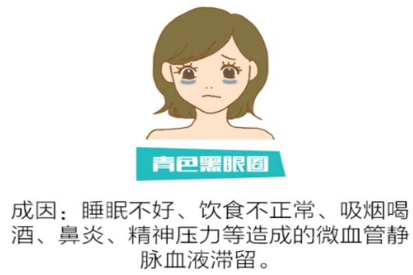 如何分辨黑眼圈類型 找對類型對癥下藥