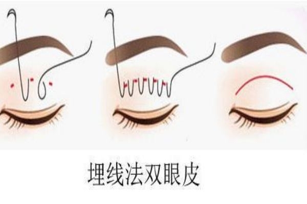 埋線雙眼皮感染怎么辦？埋線雙眼皮發(fā)炎了怎么辦