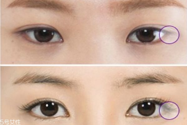 眼瞼下至術是什么 眼瞼下至術的手術原理
