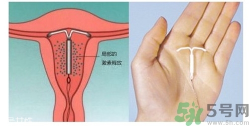 上環(huán)是什么意思？上環(huán)后注意事項(xiàng)有哪些？