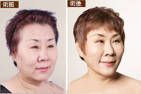 拉皮手術(shù)多久能恢復(fù) 拉皮手術(shù)會留疤嗎