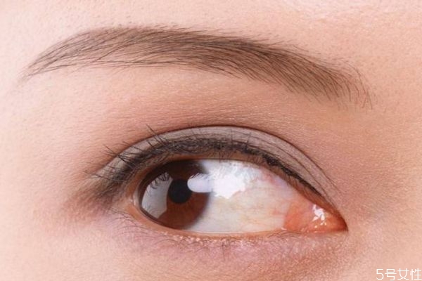 開(kāi)眼角多久可以恢復(fù)呢 開(kāi)眼角什么時(shí)候看沾水呢