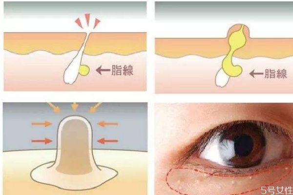 脂肪粒是怎么形成的呢 脂肪?？梢宰约汉脝?></p><h3</div>
<p class=